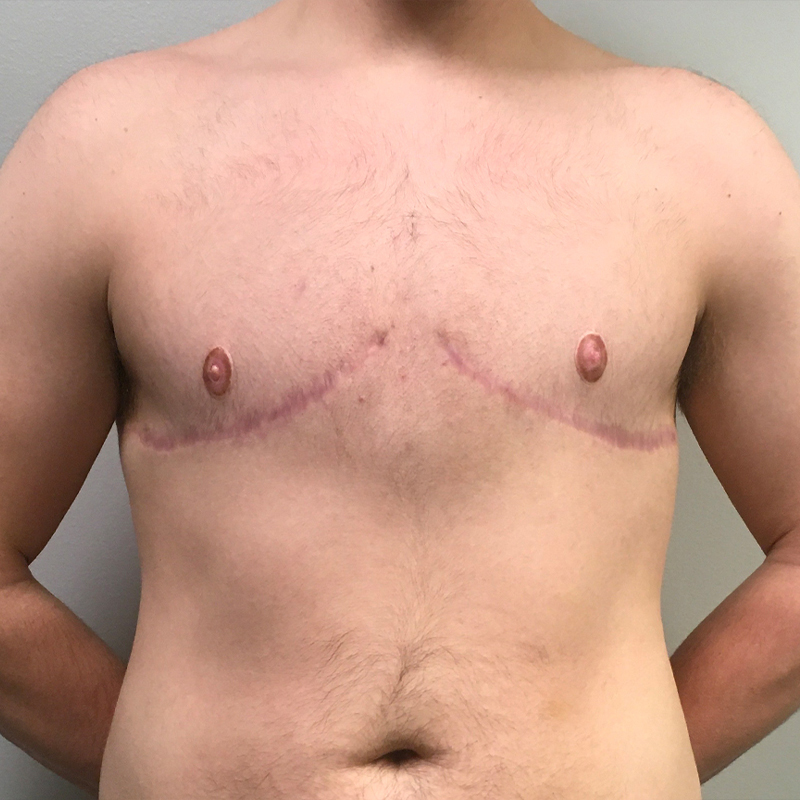 Female To Male Top Surgery 78