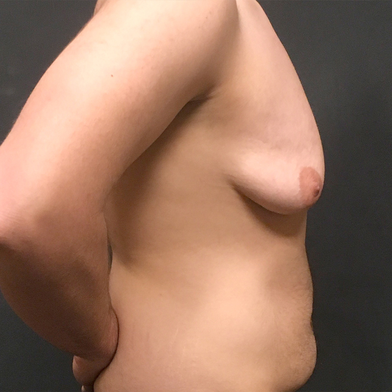 Female To Male Top Surgery 05