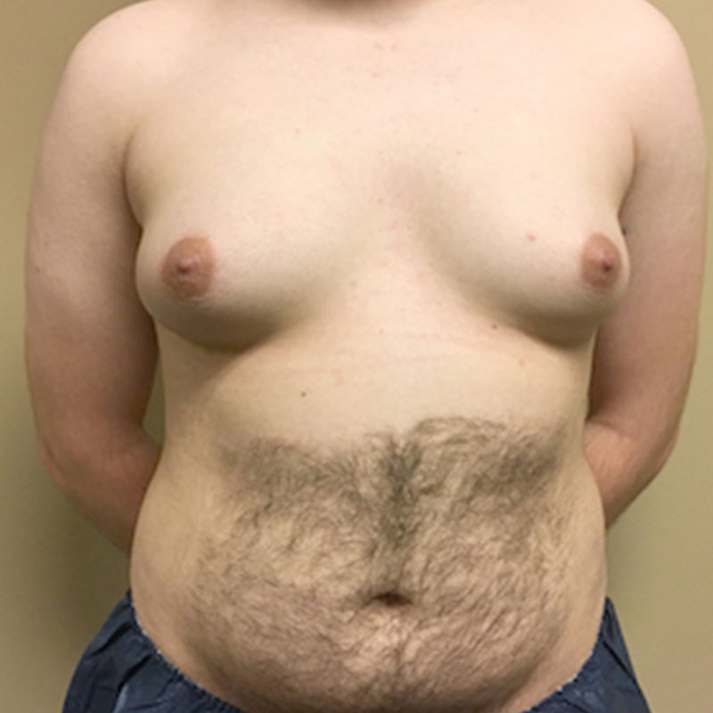 Female To Male Top Surgery 01