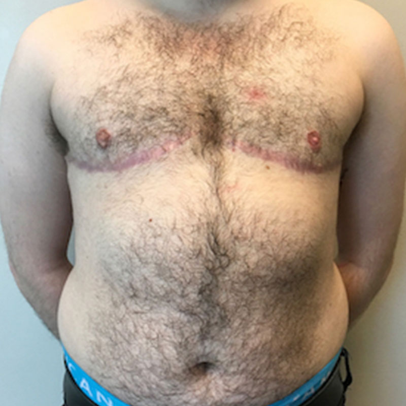 Female To Male Top Surgery 79