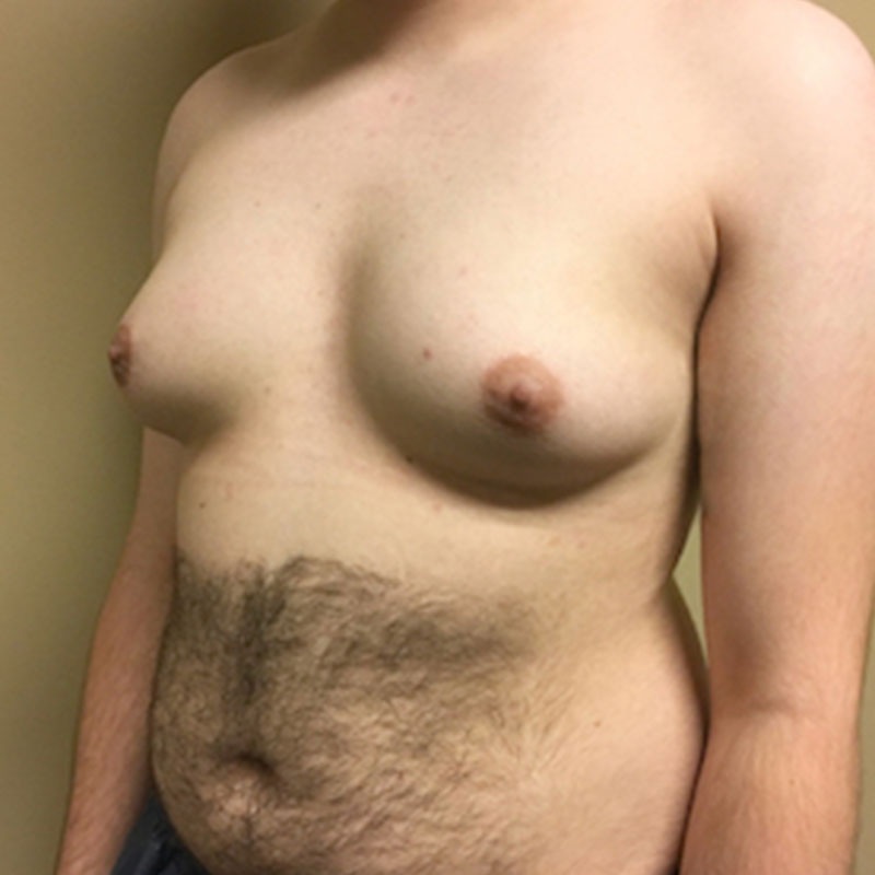 Female To Male Top Surgery 03