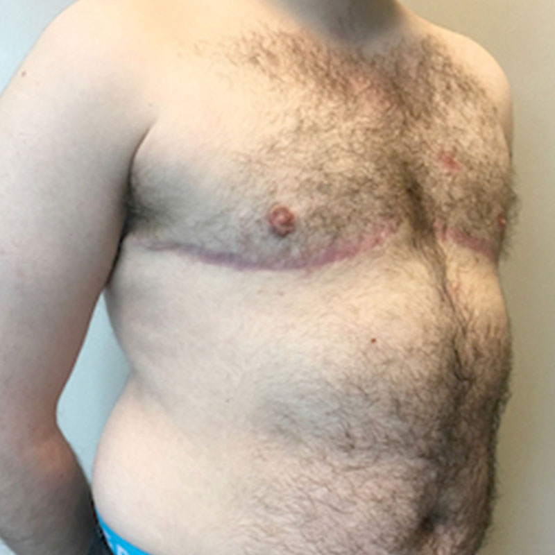 Female To Male Top Surgery 05