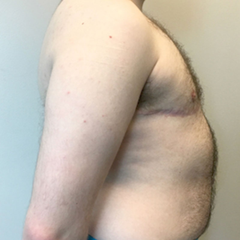 Female To Male Top Surgery 07