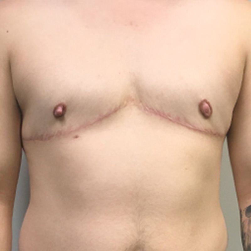 Female To Male Top Surgery 80