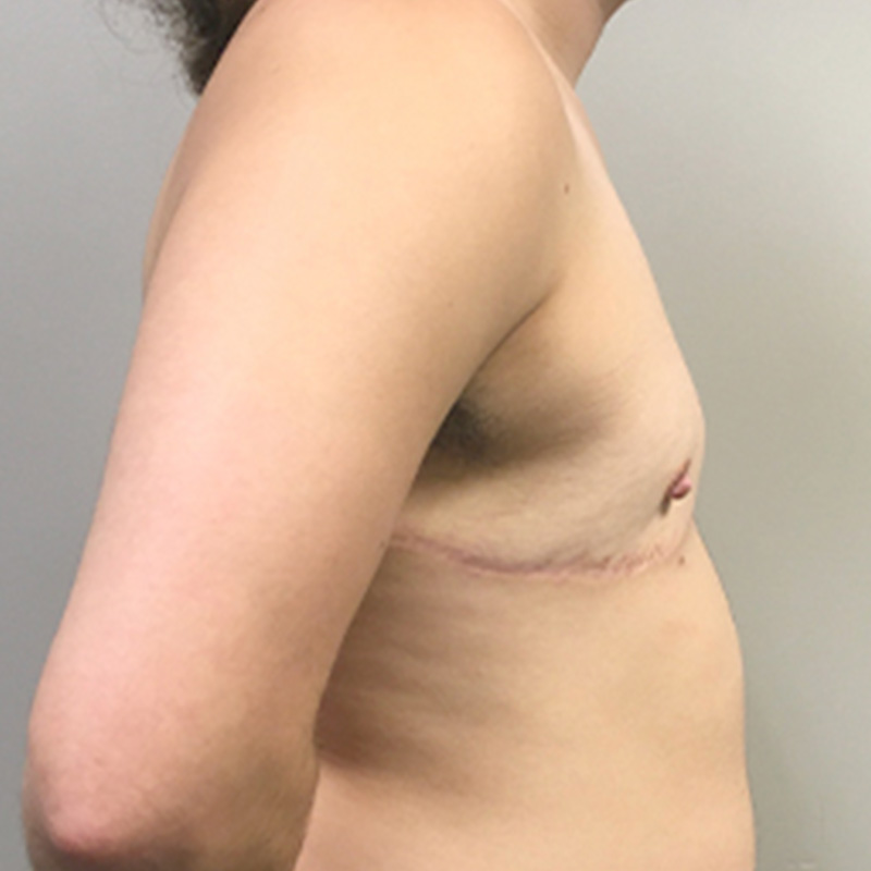 Female To Male Top Surgery 05