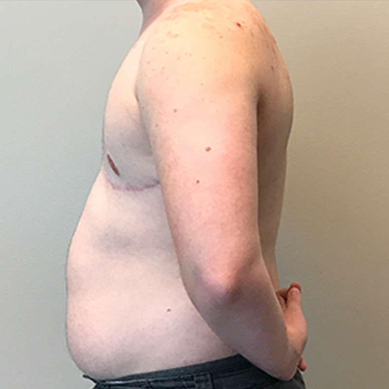 Female To Male Top Surgery 05