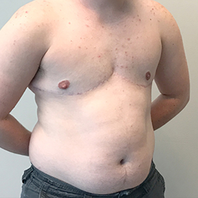 Female To Male Top Surgery 07