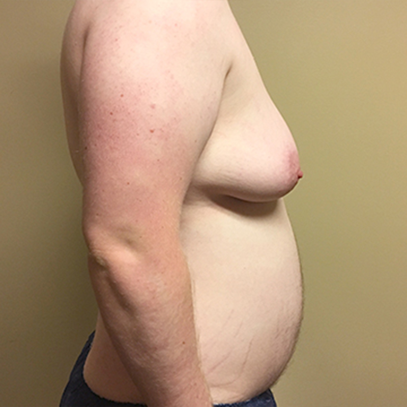 Female To Male Top Surgery 05