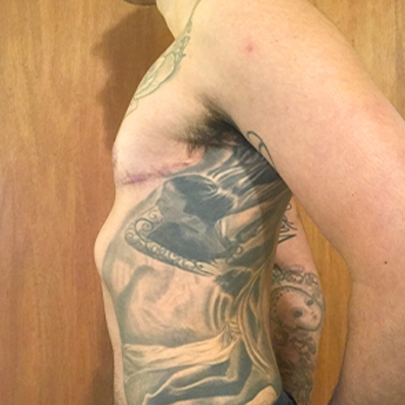 Female To Male Top Surgery 05