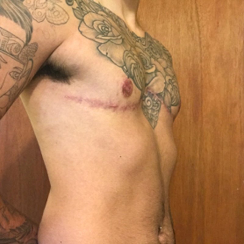 Female To Male Top Surgery 07