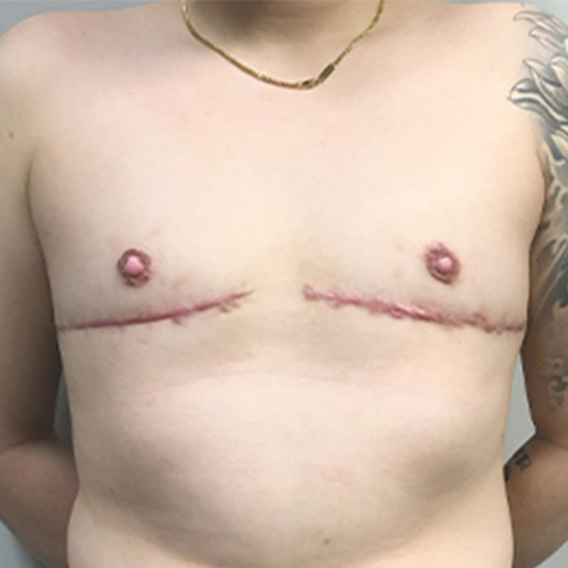 Female To Male Top Surgery 84