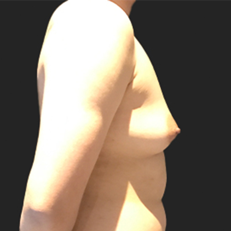 Female To Male Top Surgery 05