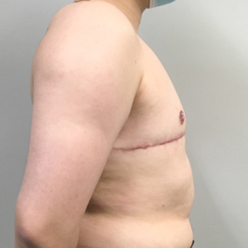 Female To Male Top Surgery 05