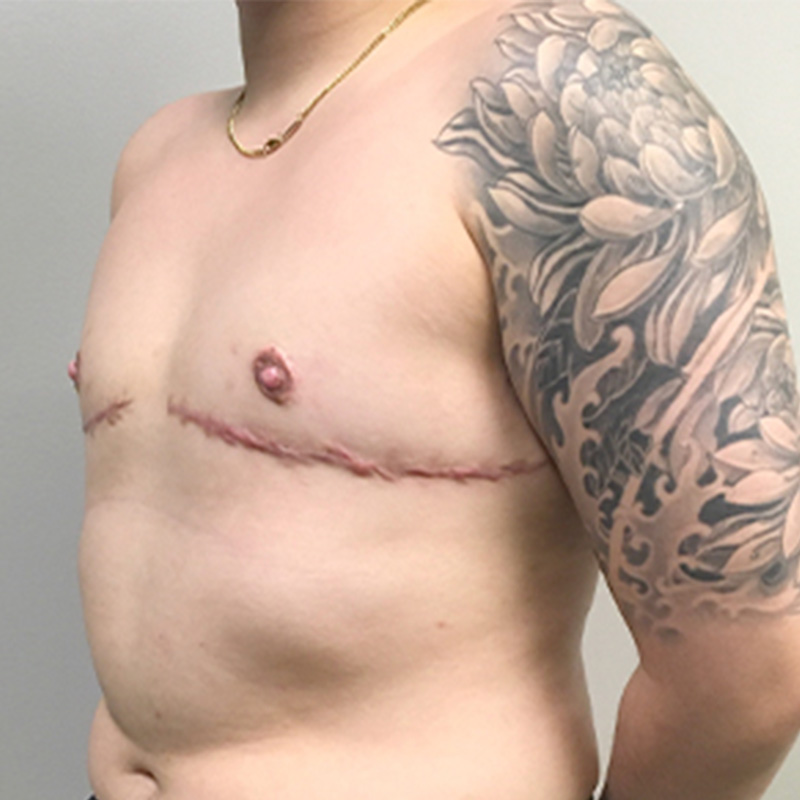 Female To Male Top Surgery 07