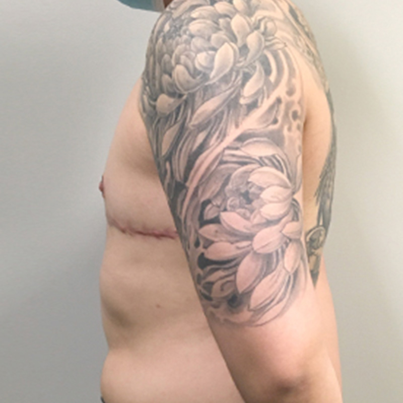 Female To Male Top Surgery 09