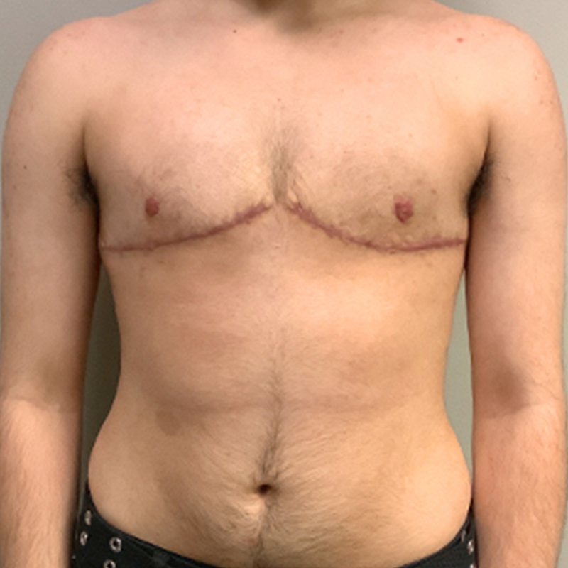 Female To Male Top Surgery 85