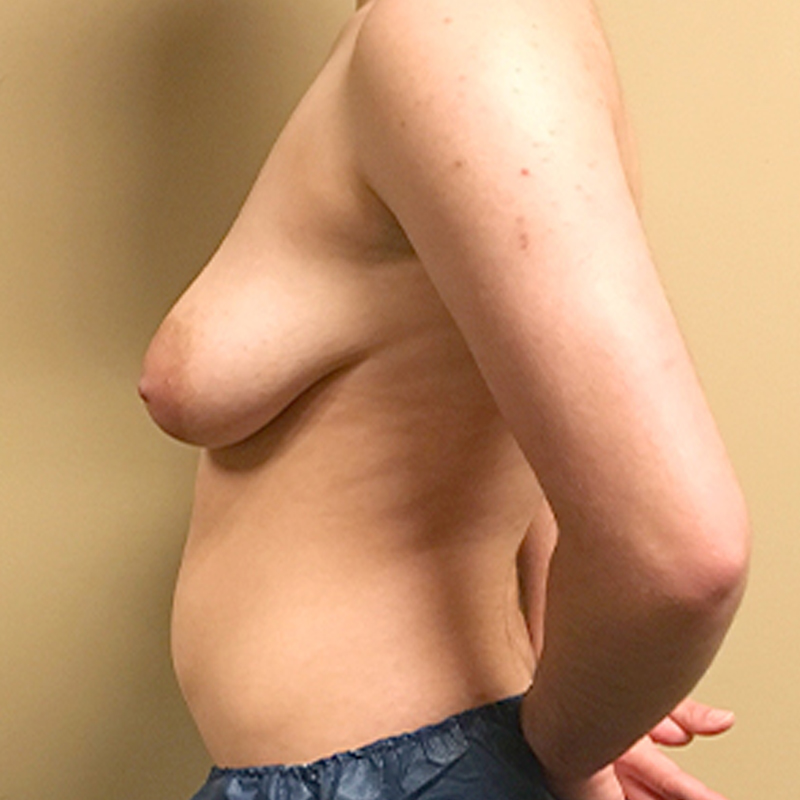 Female To Male Top Surgery 05