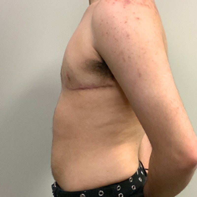 Female To Male Top Surgery 05