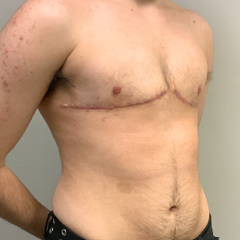 Female To Male Top Surgery 07