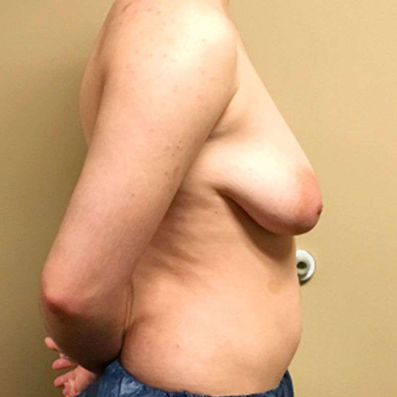 Female To Male Top Surgery 09