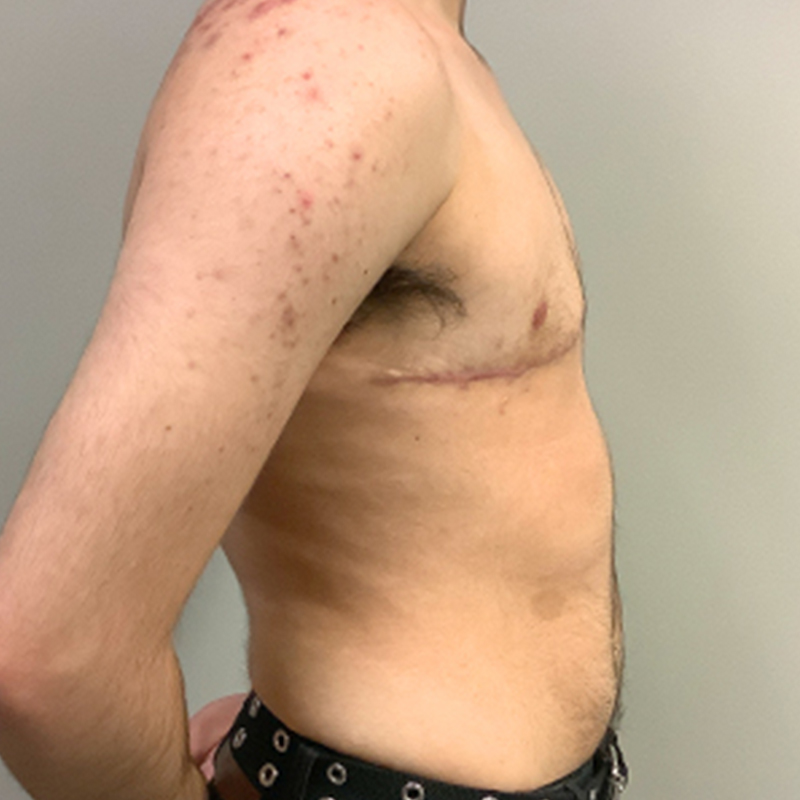 Female To Male Top Surgery 09