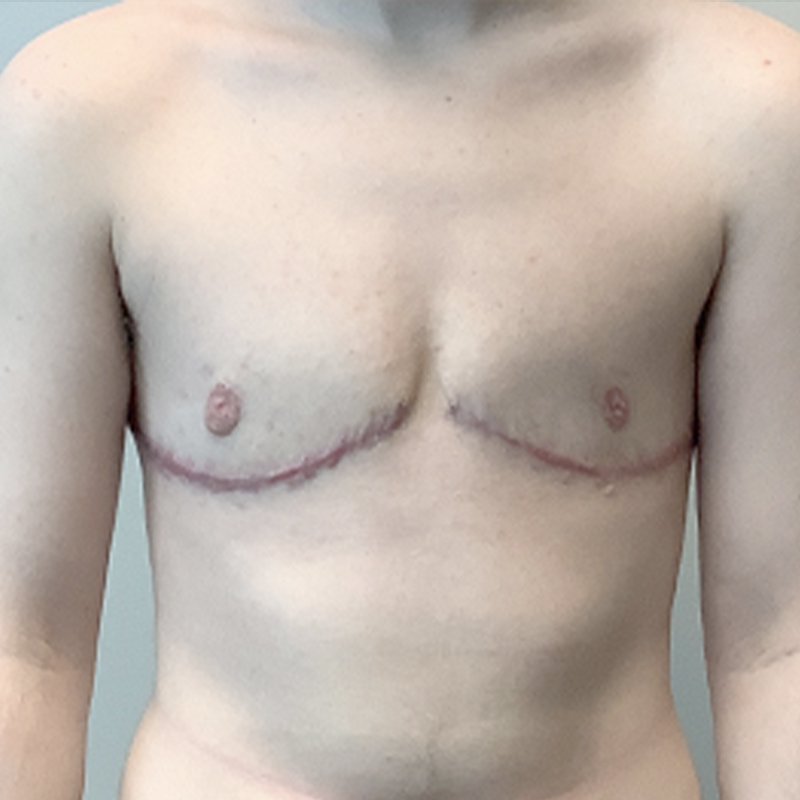 Female To Male Top Surgery 86