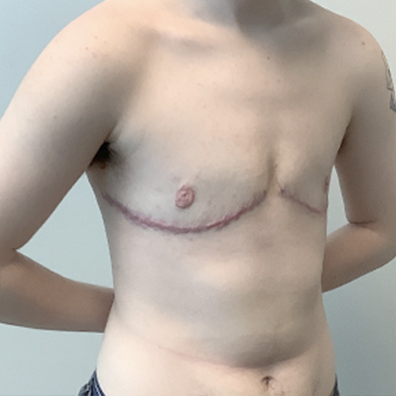 Female To Male Top Surgery 03