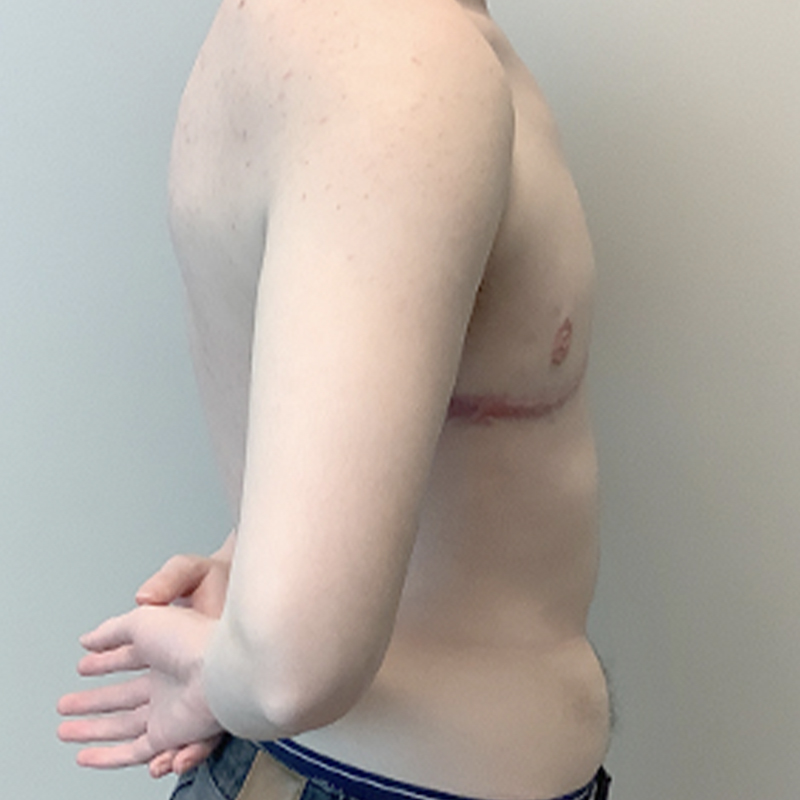 Female To Male Top Surgery 07