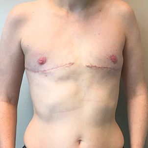 Female To Male Top Surgery 87