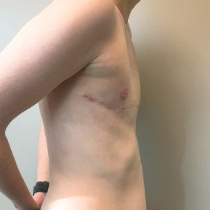 Female To Male Top Surgery 05