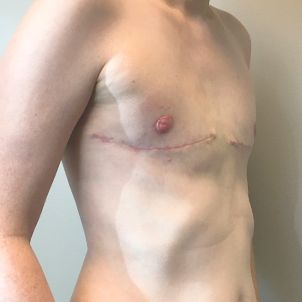 Female To Male Top Surgery 07