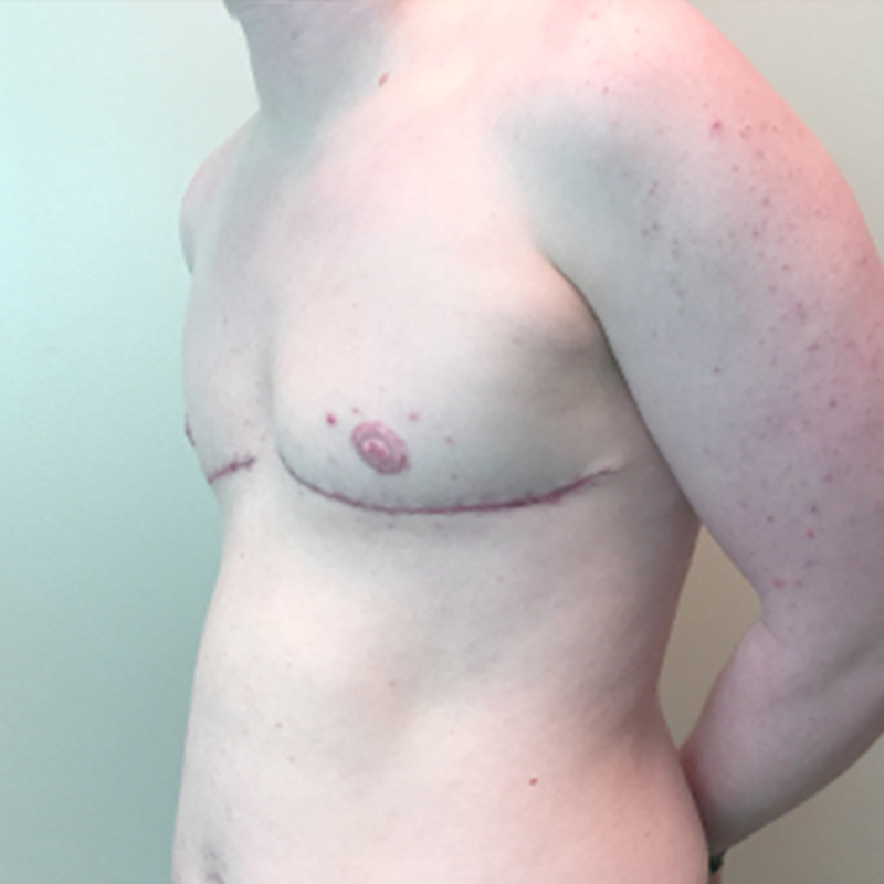 Female To Male Top Surgery 03