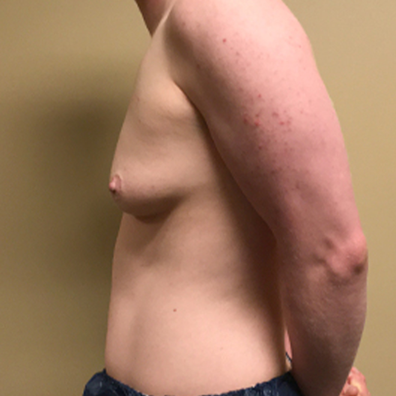 Female To Male Top Surgery 05