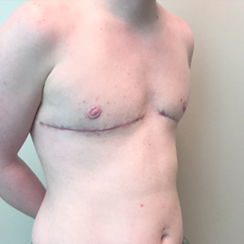 Female To Male Top Surgery 07