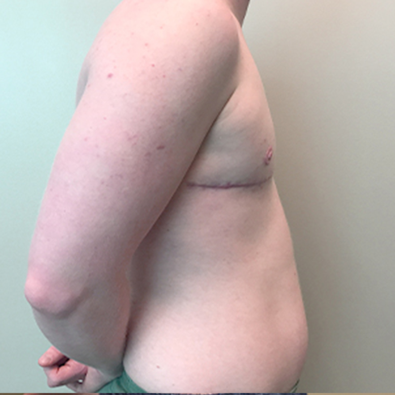 Female To Male Top Surgery 09