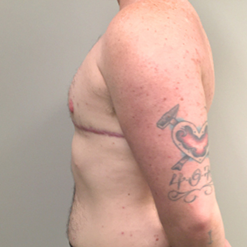 Female To Male Top Surgery 05