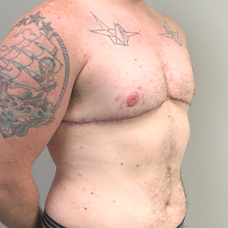 Female To Male Top Surgery 07