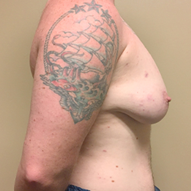 Female To Male Top Surgery 09