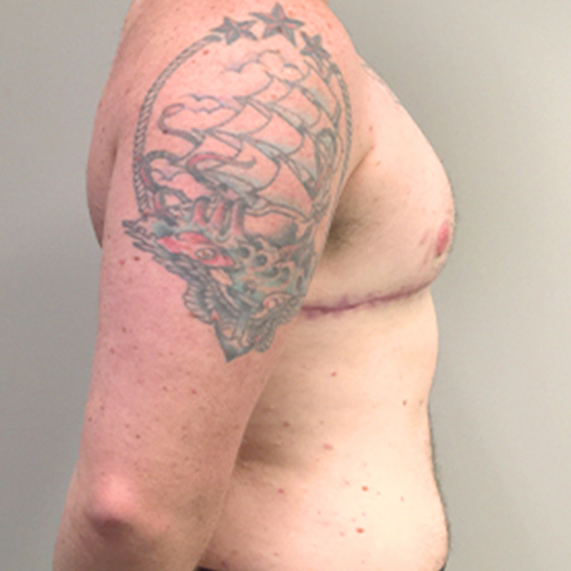 Female To Male Top Surgery 09