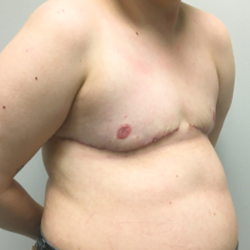 Female To Male Top Surgery 07