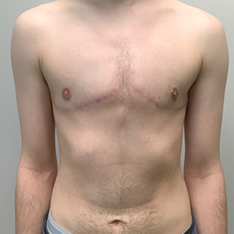 Female To Male Top Surgery 91