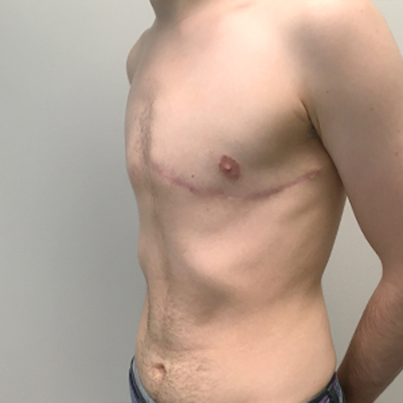 Female To Male Top Surgery 03