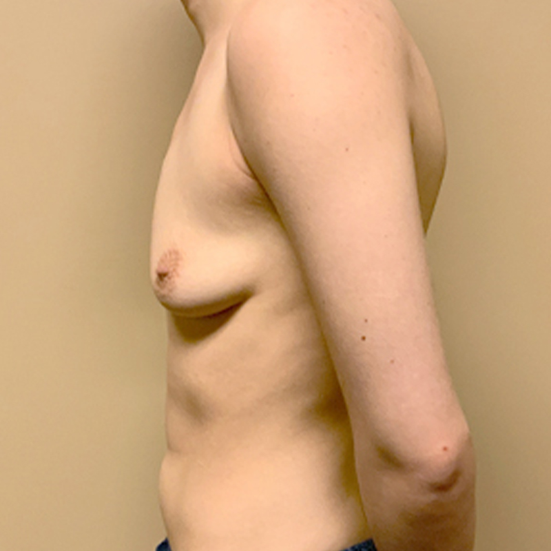 Female To Male Top Surgery 05