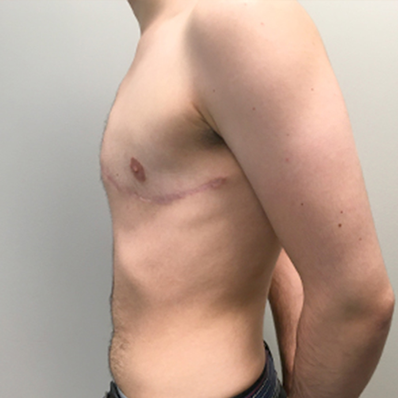 Female To Male Top Surgery 05