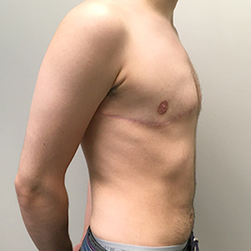 Female To Male Top Surgery 09