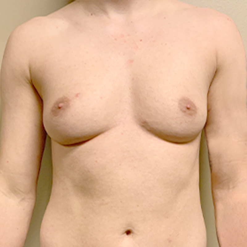 Female To Male Top Surgery 01