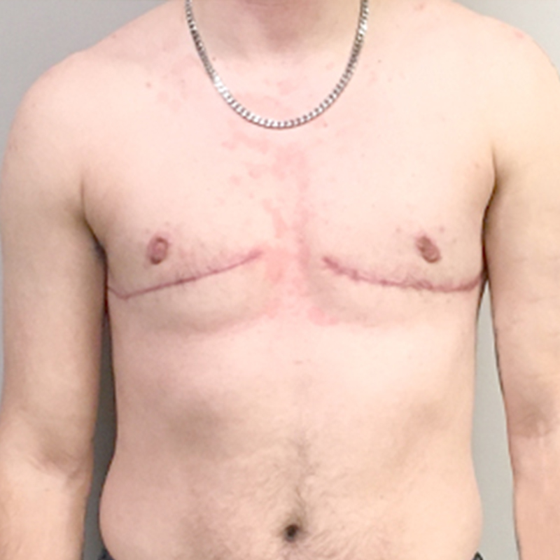 Female To Male Top Surgery 92