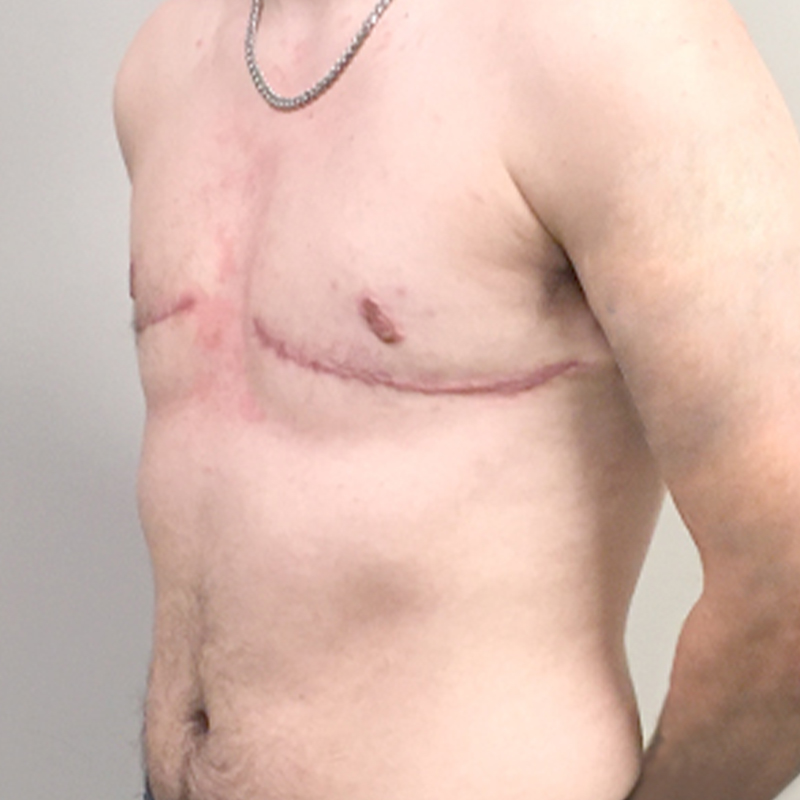 Female To Male Top Surgery 03