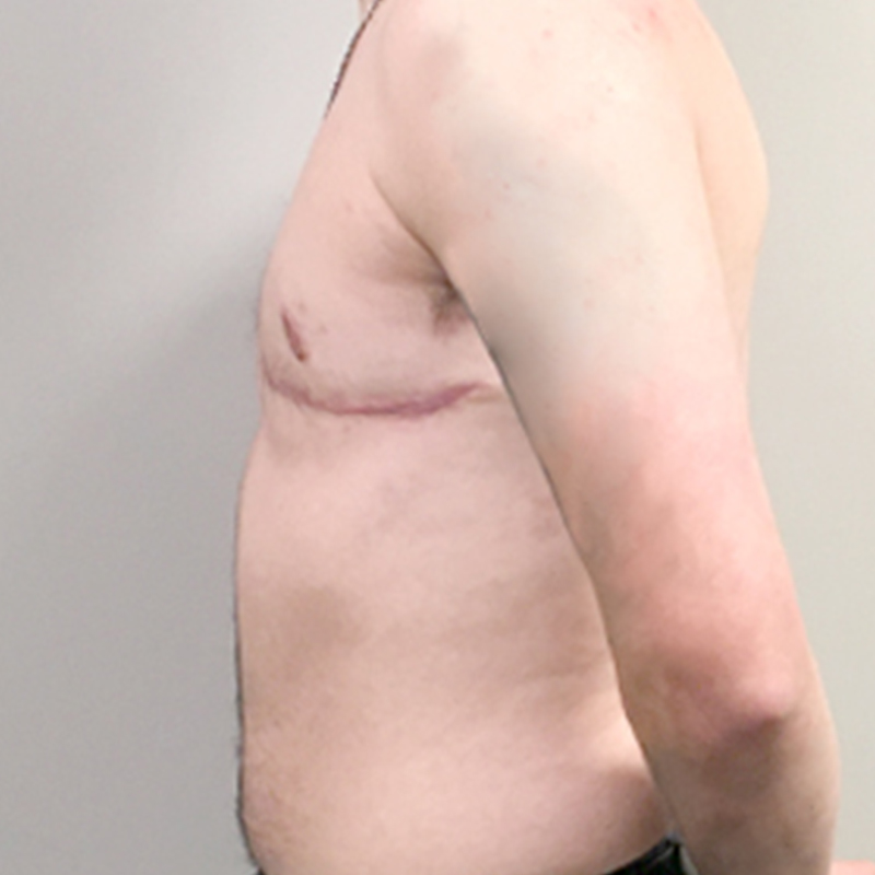 Female To Male Top Surgery 05