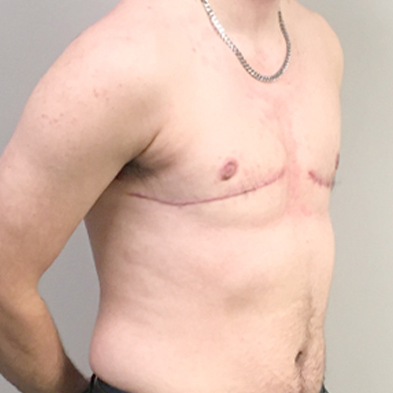 Female To Male Top Surgery 07